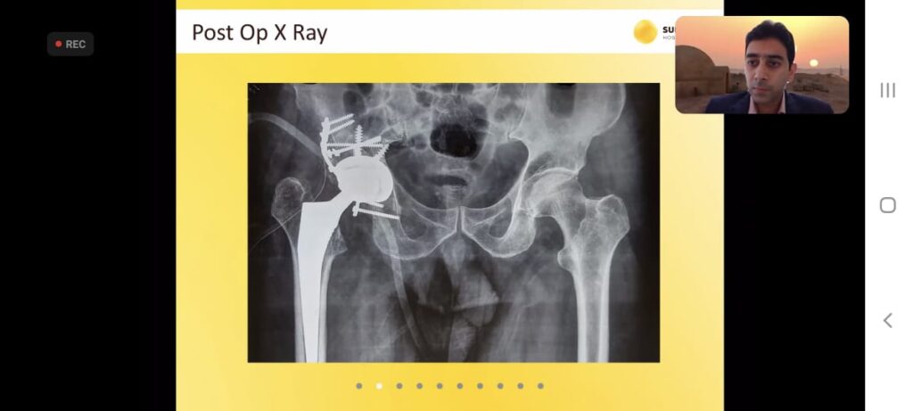 Meril Master’S Course On Complex Primary Hip Replacement Surgery