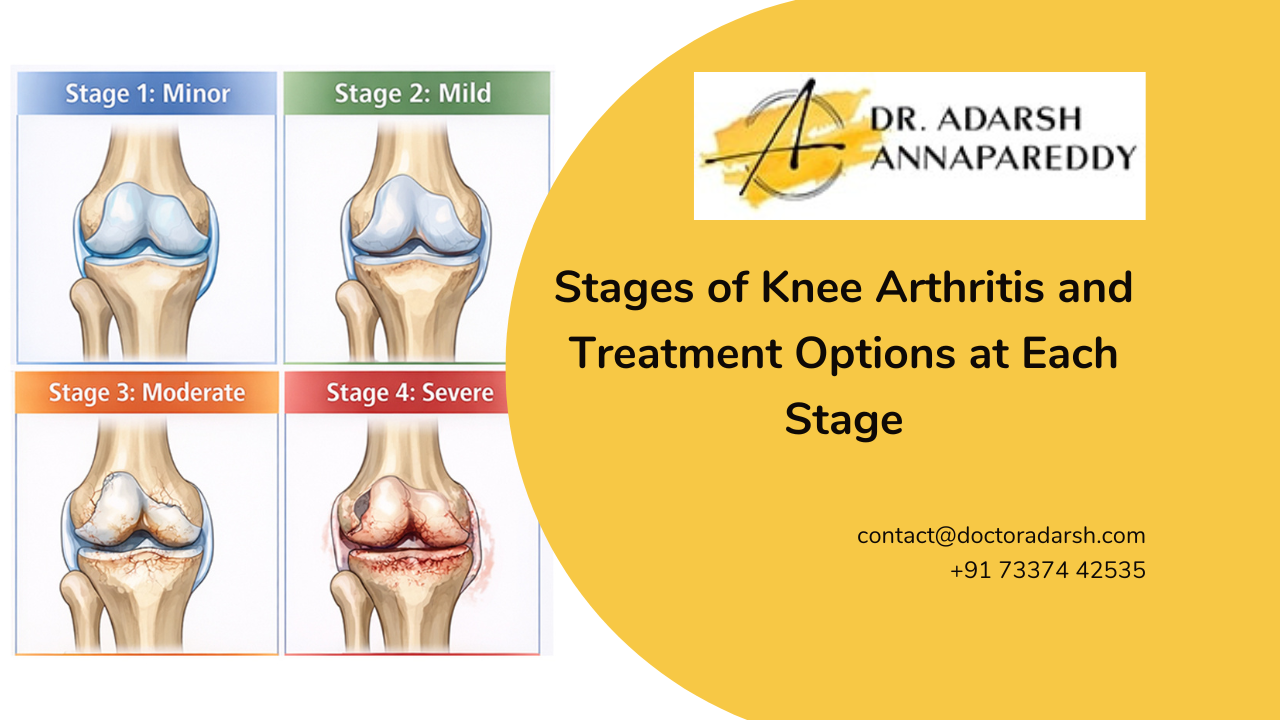 Stages of Knee Arthritis and Treatment Options at Each Stage