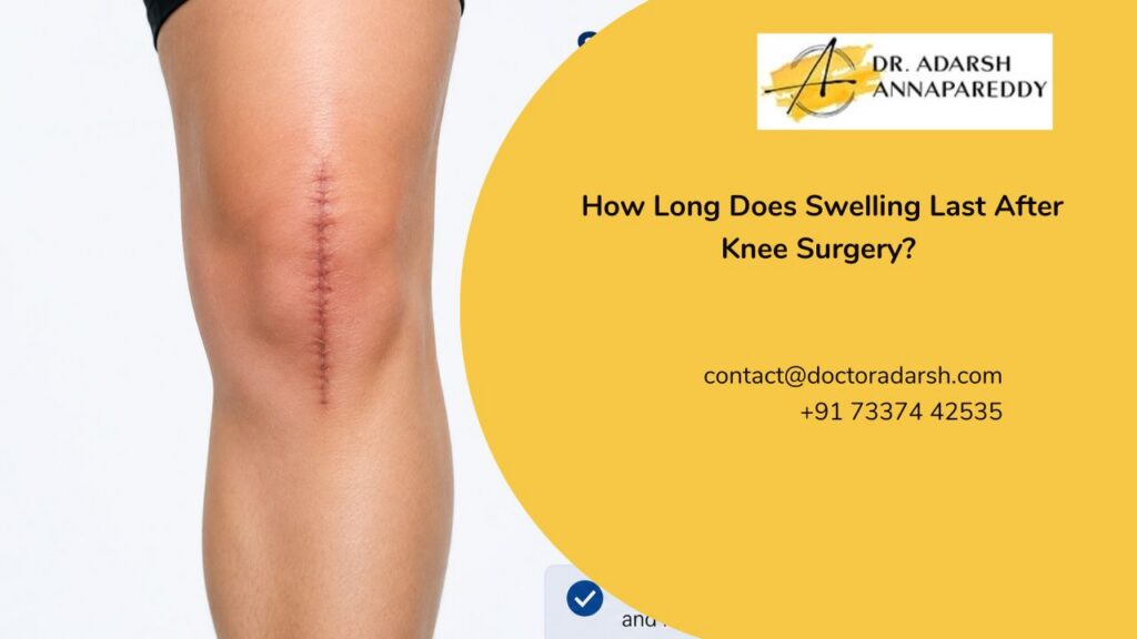 How Long Does Swelling Last After Knee Surgery?